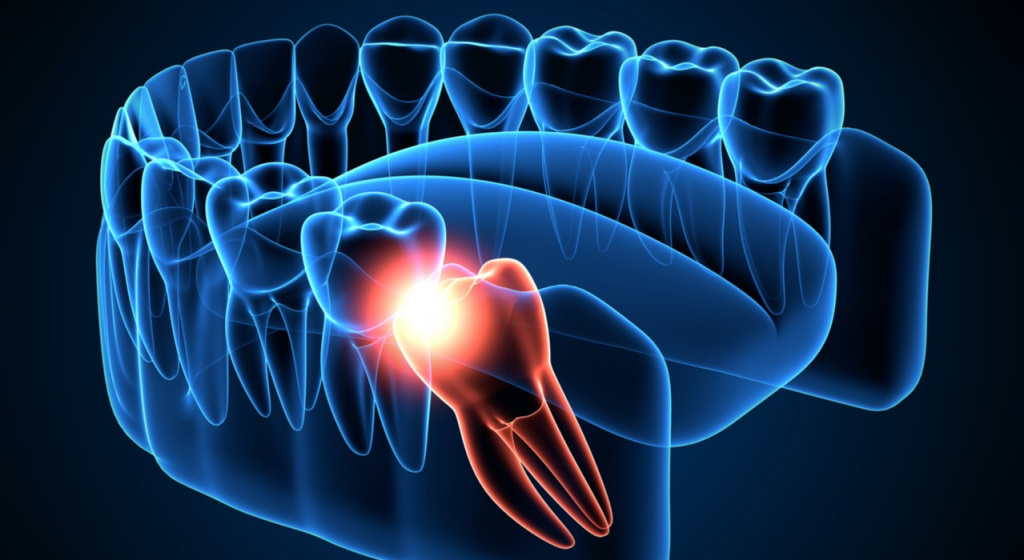 Зубы мудрости удаление зубы мудрости, зуб, зубы, третий моляр, третьи моляры, у всех ли есть зубы мудрости, зубы мудрости вред, расположение зубов мудрости, удаление зуба мудрости, прорезывание зуба мудрости, зубы мудрости удалять